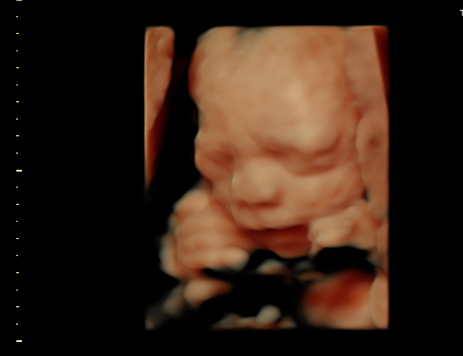 3D ultrasound image at 25 weeks